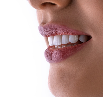 A close-up of a smile after tooth bonding