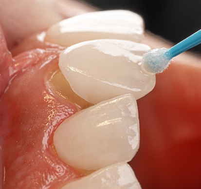 A close-up of a porcelain veneer being placed on a front tooth