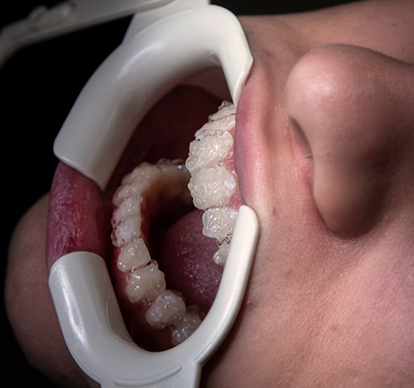 Teeth being whitened in a dental chair
