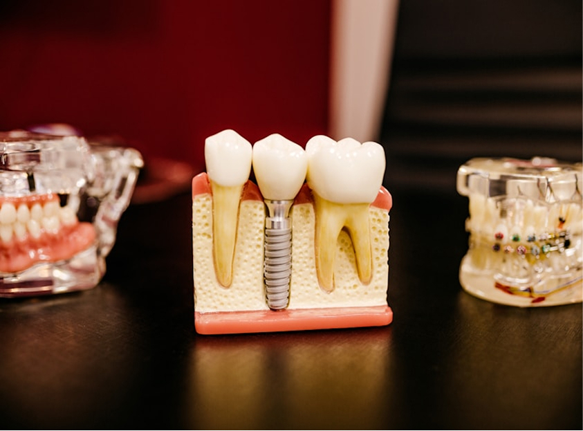 Dental Implants 101